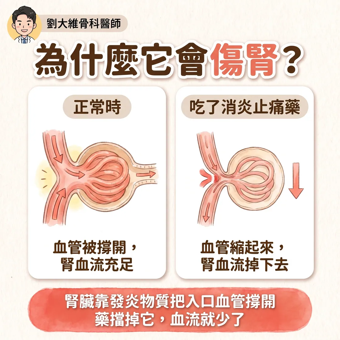 NSAID 類止痛藥全解析：常見種類、與普拿疼的差別、傷腎機轉與替代方案 衛教圖 5
