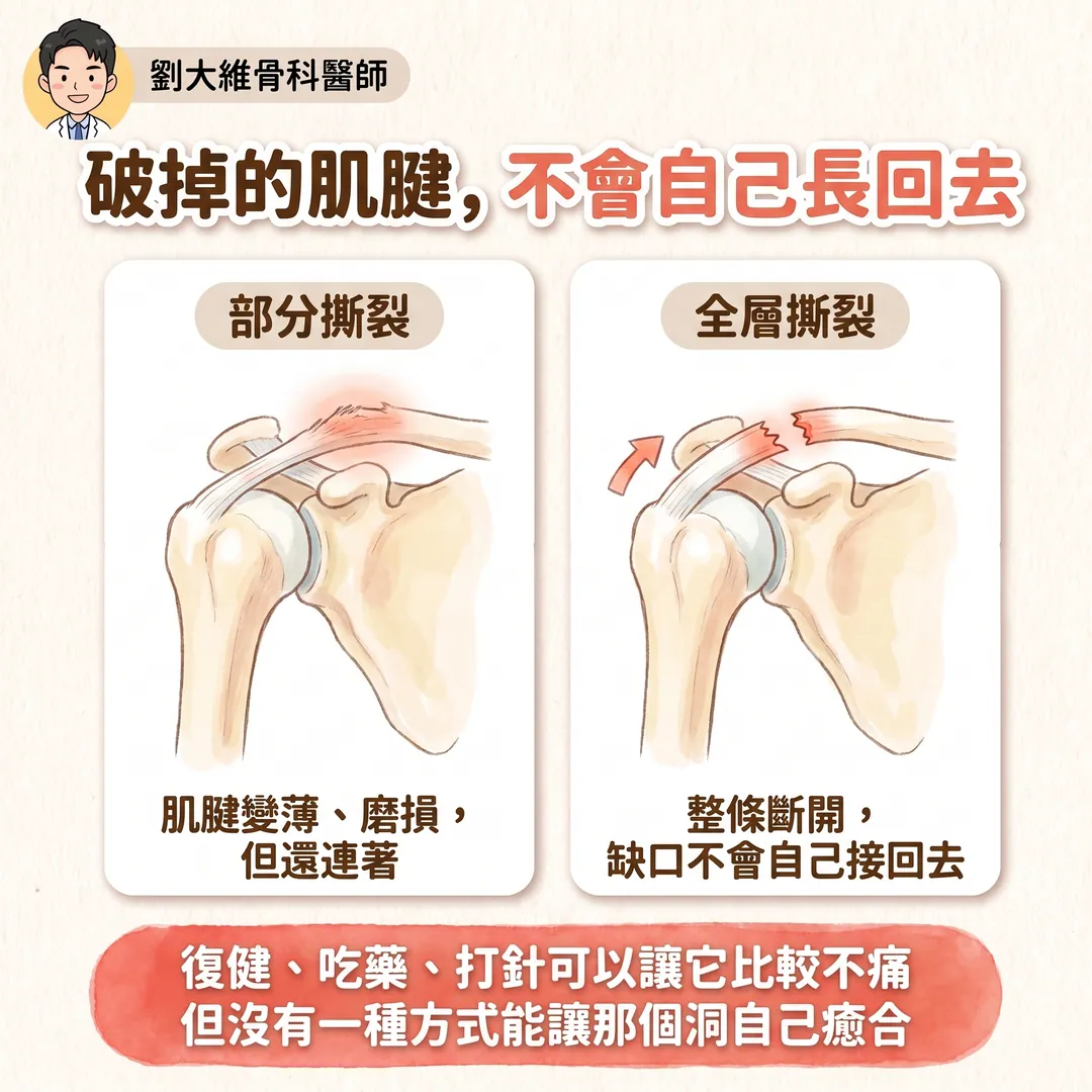 旋轉肌袖撕裂：什麼時候該開刀？PRP 到底有沒有效？ 衛教圖 2