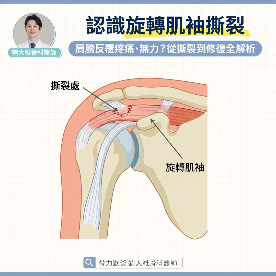 肩膀舉不高、半夜痛醒？當心是「旋轉肌袖撕裂」