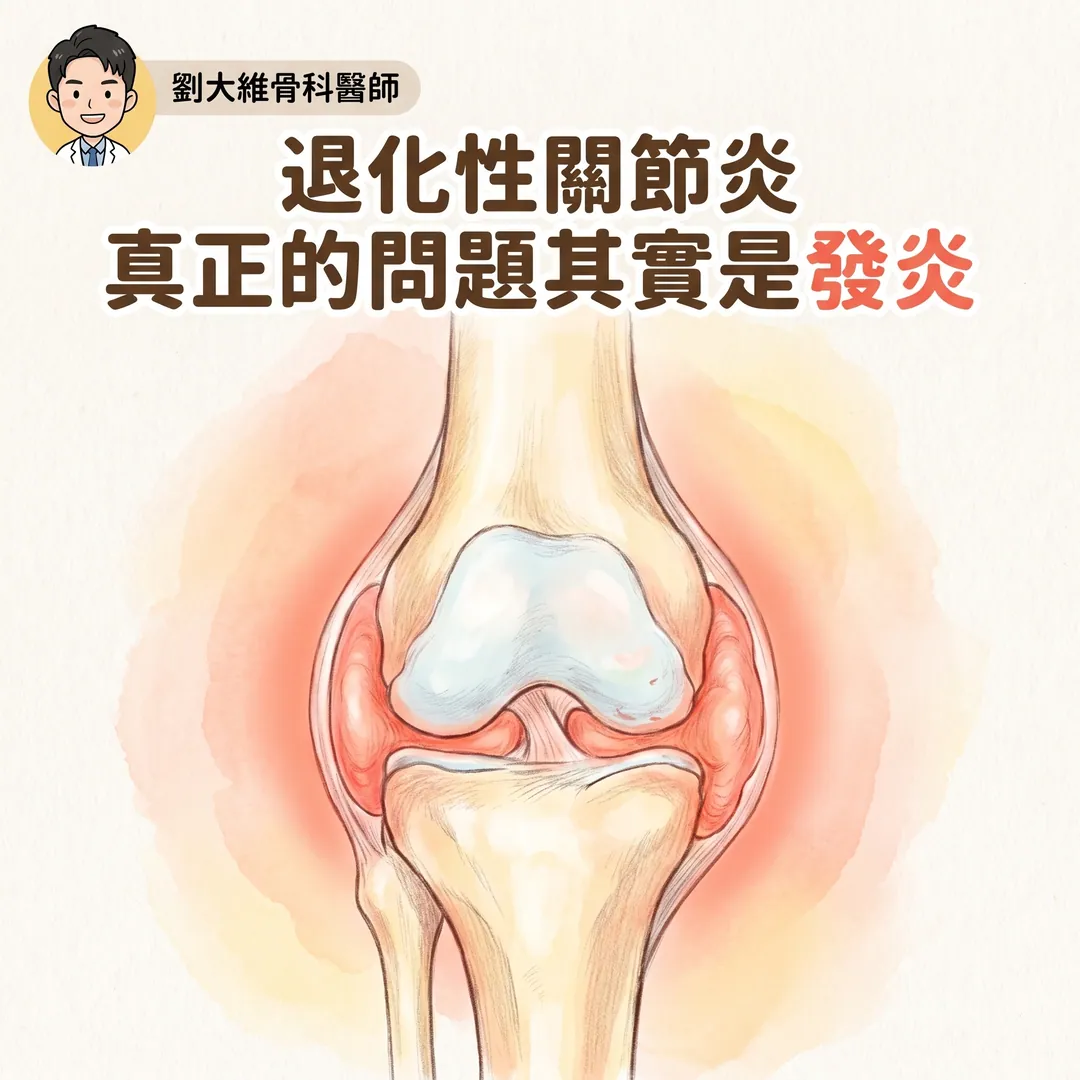 退化性關節炎：或許重點不是退化，而是發炎