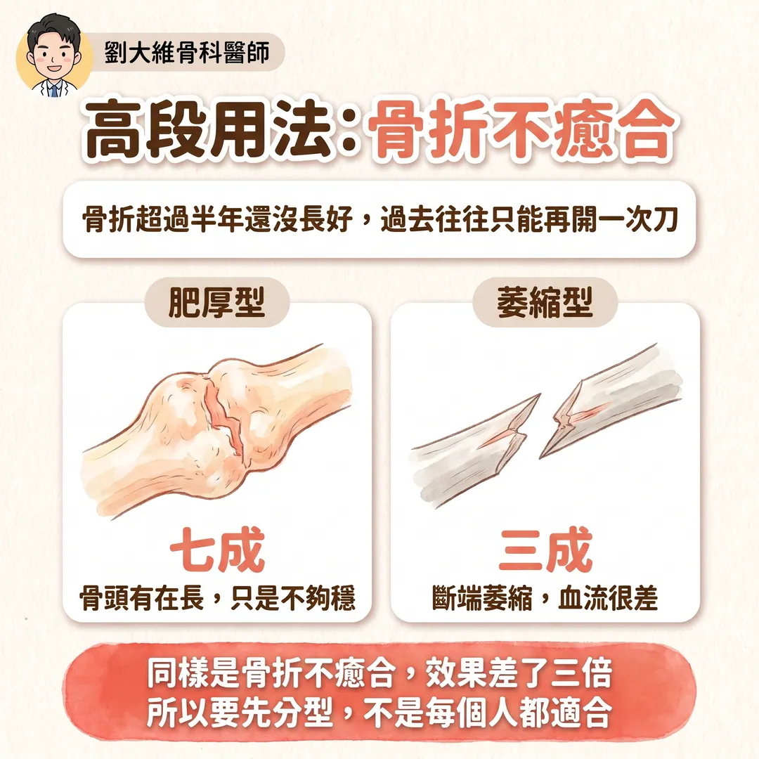 震波治療（ESWT）完整整理：原理、適應症、以及骨不癒合與骨壞死的應用 衛教圖 7