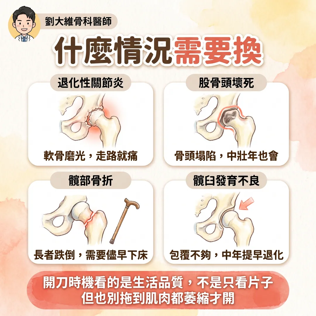 人工髖關節置換手術大全 衛教圖 2